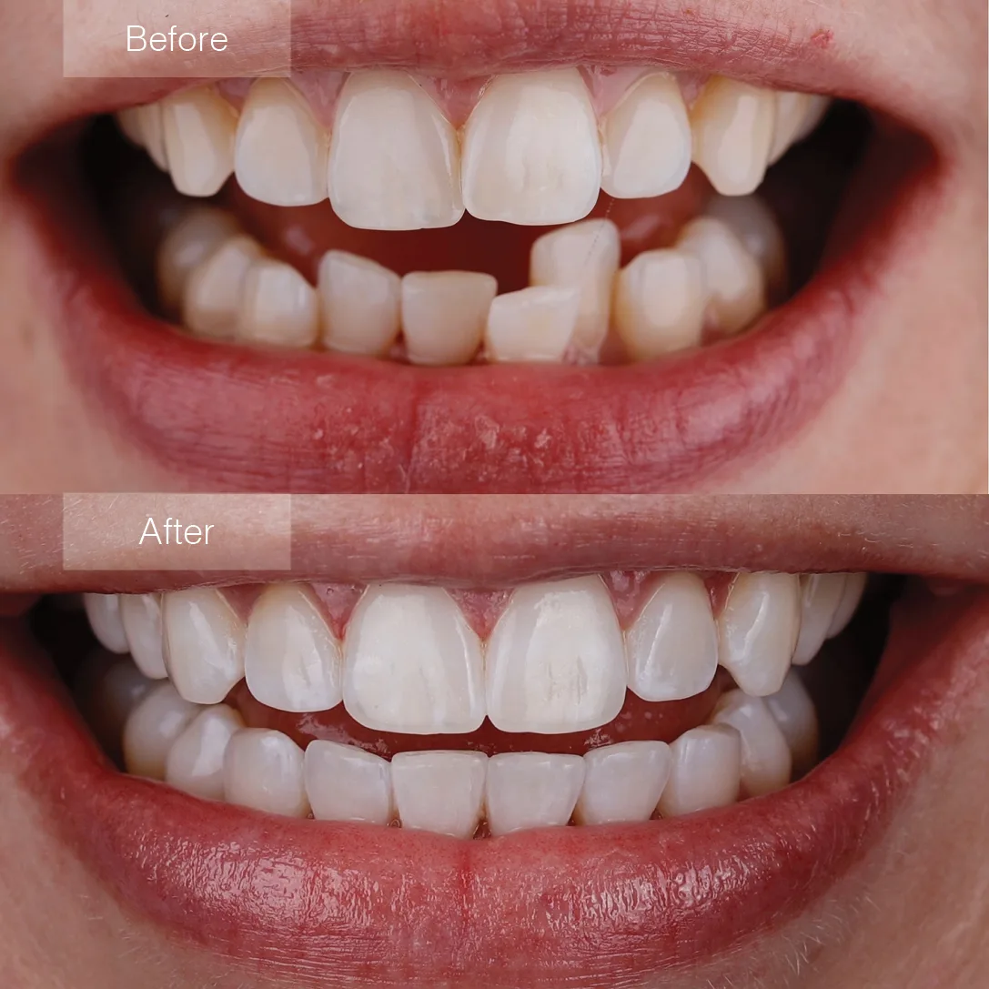 Before and after smile transformation