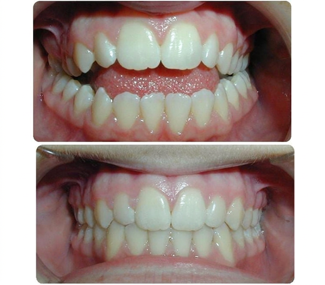 Before and after smile transformation