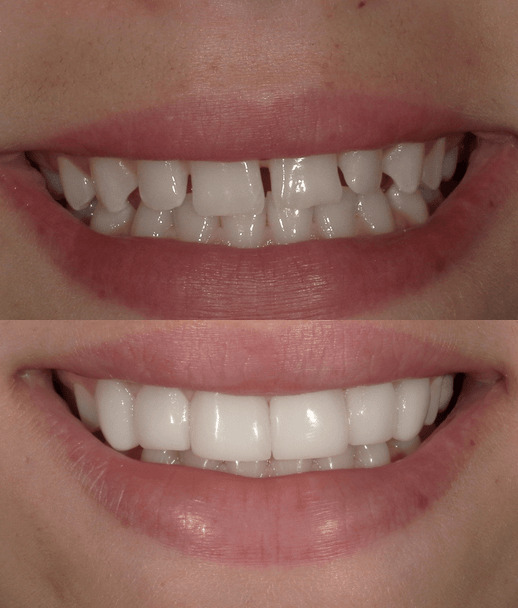 Before and after smile transformation