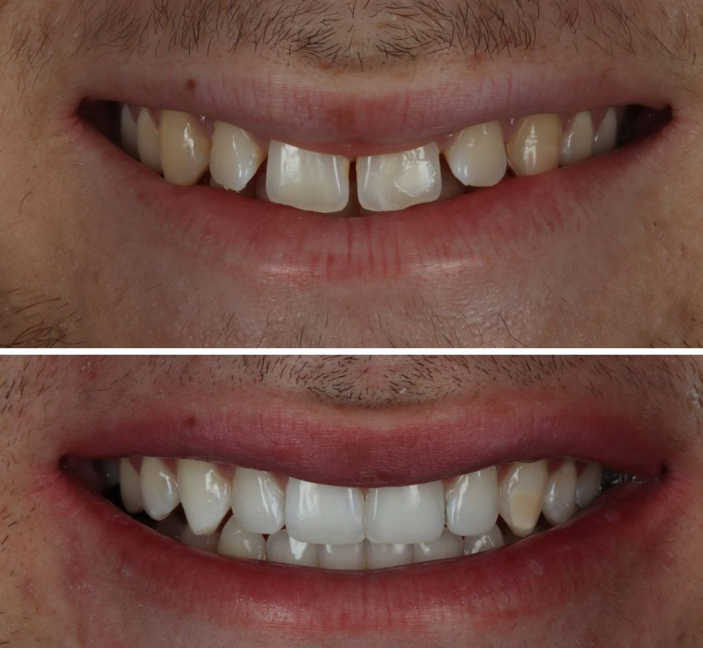 Before and after smile transformation