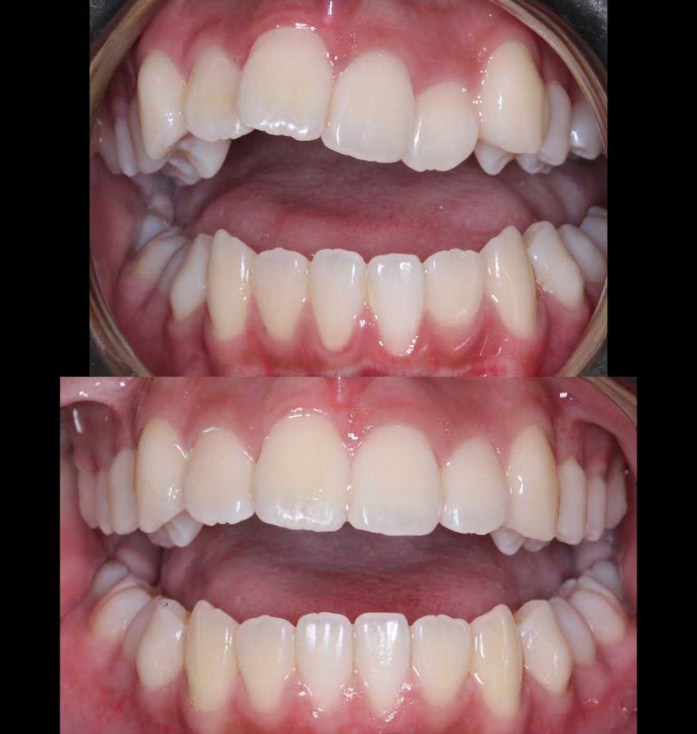 Before and after smile transformation
